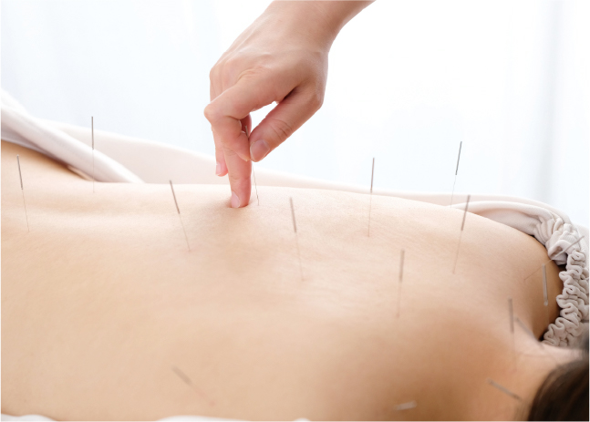 鍼灸治療の様子
